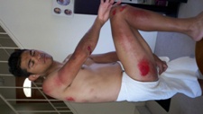 Right-side road rash from shoulder to arse to calf - ADM Crashes at Dana Point Grand Prix - 06 May 2012