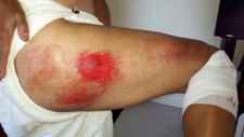 Serious butt cheak road rash (on top of old road rash scars) - ADM Crashes at Dana Point Grand Prix - 06 May 2012